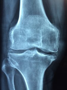arthritis knee pain relief